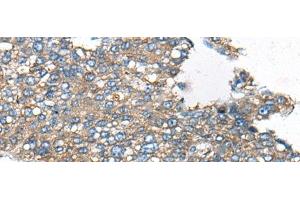 Immunohistochemistry of paraffin-embedded Human liver cancer tissue using CDC42BPA Polyclonal Antibody at dilution of 1:60(x200)
