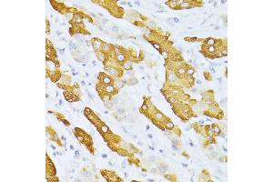 Immunohistochemistry of paraffin-embedded human liver cancer using CYP2E1 antibody (ABIN5971187) at dilution of 1/100 (40x lens). (CYP2E1 anticorps)