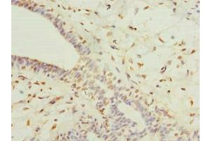 Immunohistochemistry of paraffin-embedded human breast cancer using ABIN7164641 at dilution of 1:100 (GLT25D2 anticorps  (AA 351-626))