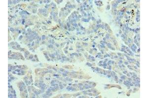 Immunohistochemistry of paraffin-embedded human lung cancer using ABIN7155475 at dilution of 1:100