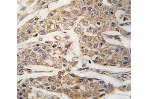 IHC analysis of FFPE human breast carcinoma tissue stained with PKM2 antibody (PKM2 anticorps  (AA 460-489))