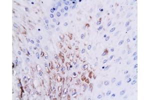 Formalin-fixed and paraffin embedded human esophageal cancer tissue labeled with Anti-WIG 1/PAG608 (3E4) Monoclonal Antibody, Unconjugated(bsm-0957M) at 1:200 followed by conjugation to the secondary antibody and DAB staining