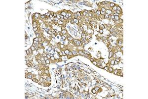 Immunohistochemistry of paraffin-embedded human lung cancer using Calumenin Rabbit mAb (ABIN7266050) at dilution of 1:25 (40x lens). (CALU anticorps)