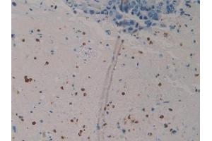 Detection of S100P in Human Breast cancer Tissue using Polyclonal Antibody to S100 Calcium Binding Protein P (S100P)