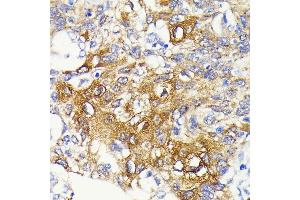 Immunohistochemistry of paraffin-embedded human lung cancer using IKKβ antibody (ABIN7267873) at dilution of 1:100 (40x lens).