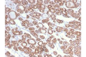 Formalin-fixed, paraffin-embedded human Thyroid Carcinoma stained with CK18 Rabbit Recombinant Monoclonal Antibody (KRT18/2808R).