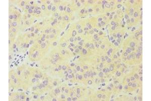 Immunohistochemistry of paraffin-embedded human liver cancer using ABIN7174019 at dilution of 1:100 (FES anticorps  (AA 120-420))