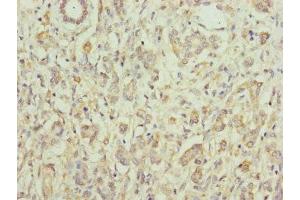 Immunohistochemistry of paraffin-embedded human pancreatic cancer using ABIN7152171 at dilution of 1:100 (Eukaryotic Translation Initiation Factor 3, Subunit M (EIF3M) (AA 1-374) anticorps)
