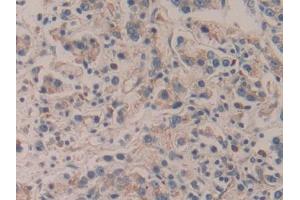 DAB staining on IHC-P; Samples: Human Prostate cancer Tissue
