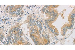 Immunohistochemistry of paraffin-embedded Human colon cancer tissue using ZWINT Polyclonal Antibody at dilution 1:50 (ZWINT anticorps)