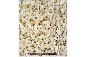 SGP Antibody (Center) (ABIN651464 and ABIN2840255) immunohistochemistry analysis in forlin fixed and paraffin embedded hun breast carcino followed by peroxidase conjugation of the secondary antibody and DAB staining. (SMAGP anticorps  (AA 46-75))