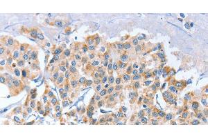 Immunohistochemistry of paraffin-embedded Human breast cancer using APOBEC3D Polyclonal Antibody at dilution of 1:80 (APOBEC3D anticorps)