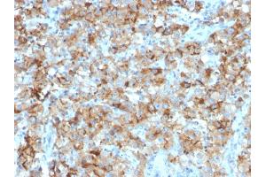 Formalin-fixed, paraffin-embedded human Testicular Carcinoma stained with StAR Mouse Monoclonal Antibody (STAR/2154). (STAR anticorps  (AA 39-108))