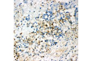 Anti- CD63 Picoband antibody, IHC(P) IHC(P): Human Intestinal Cancer Tissue (CD63 anticorps  (AA 97-238))