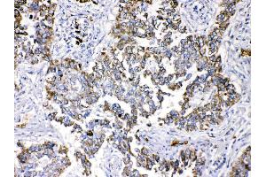 Periplakin was detected in paraffin-embedded sections of human lung cancer tissues using rabbit anti- Periplakin Antigen Affinity purified polyclonal antibody (Catalog # ) at 1 µg/mL. (PPL anticorps  (C-Term))