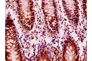 Immunohistochemistry of paraffin-embedded human colon cancer using ABIN7152940 at dilution of 1:100