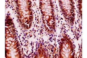 Immunohistochemistry of paraffin-embedded human colon cancer using ABIN7152940 at dilution of 1:100 (FIL1L anticorps  (AA 1-200))