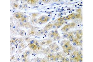 Immunohistochemistry of paraffin-embedded Human liver cancer using RARRES2 Polyclonal Antibody at dilution of 1:200 (40x lens). (Chemerin anticorps)