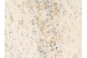 ABIN6264988 and ABIN6266659 at 1/100 staining human prostate carcinoma by IHC-P.