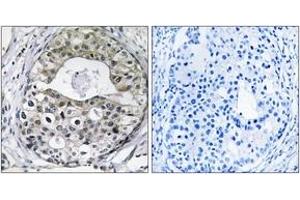 Immunohistochemistry analysis of paraffin-embedded human breast carcinoma tissue, using RPS13 Antibody. (RPS13 anticorps  (AA 71-120))