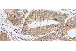 Immunohistochemistry of paraffin-embedded Human colorectal cancer tissue using MARCKSL1 Polyclonal Antibody at dilution of 1:50(x200) (MARCKSL1 anticorps)