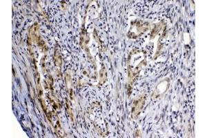 IHC testing of FFPE human rectal cancer tissue with MED4 antibody at 1ug/ml.