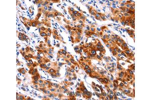 Immunohistochemistry of Human thyroid cancer using SEPT4 Polyclonal Antibody at dilution of 1:50 (Septin 4 anticorps)