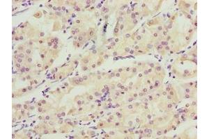 Immunohistochemistry of paraffin-embedded human gastric cancer using ABIN7175738 at dilution of 1:100 (WDR34 anticorps  (AA 1-210))
