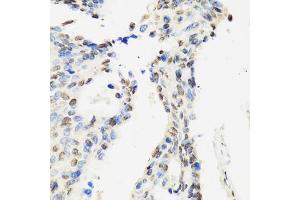 Immunohistochemistry of paraffin-embedded human rectal cancer using CC antibody (ABIN6133528, ABIN6138034, ABIN6138035 and ABIN6222941) at dilution of 1:100 (40x lens). (CCAR2 anticorps  (AA 654-923))