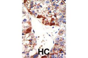 Formalin-fixed and paraffin-embedded human hepatocellular carcinoma tissue reacted with NUB1 polyclonal antibody  , which was peroxidase-conjugated to the secondary antibody, followed by DAB staining . (NUB1 anticorps  (N-Term))