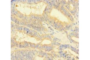 Immunohistochemistry of paraffin-embedded human endometrial cancer using ABIN7165861 at dilution of 1:100 (NIPSNAP3B anticorps  (AA 1-247))