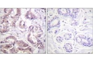 Immunohistochemistry analysis of paraffin-embedded human breast carcinoma tissue, using Survivin (Ab-34) Antibody. (Survivin anticorps  (AA 11-60))