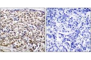 Immunohistochemistry analysis of paraffin-embedded human breast carcinoma tissue, using CREB (Ab-129) Antibody.