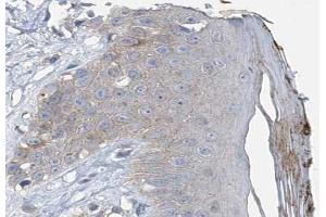 ABIN6267546 at 1/100 staining human Skin cancer tissue sections by IHC-P.