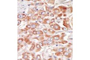 Formalin-fixed and paraffin-embedded human cancer tissue reacted with the primary antibody, which was peroxidase-conjugated to the secondary antibody, followed by DAB staining. (SRPK3 anticorps  (Middle Region))