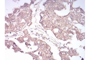 Immunohistochemical analysis of paraffin-embedded ovarian cancer tissues using Rab13 mouse mAb with DAB staining.