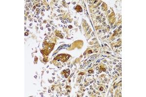 Immunohistochemistry of paraffin-embedded human uterine cancer using CAST antibody  at dilution of 1:100 (40x lens).