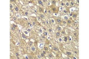 Immunohistochemistry of paraffin-embedded Human liver damage using MYBPC2 Polyclonal Antibody at dilution of 1:100 (40x lens). (MYBPC2 anticorps)