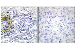Immunohistochemistry analysis of paraffin-embedded human lung carcinoma tissue using FXR2 antibody. (FXR2 anticorps  (C-Term))