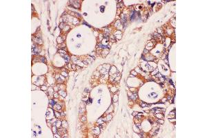 Anti-MyD88 Picoband antibody,  IHC(P): Human Intestinal Cancer Tissue