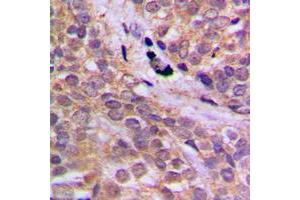 Immunohistochemical analysis of AMPK alpha 1 (pS496) staining in human breast cancer formalin fixed paraffin embedded tissue section.