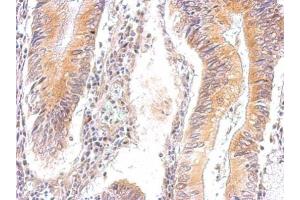 IHC-P Image AMPK gamma 2 antibody detects PRKAG2 protein at cytosol on human gastric cancer by immunohistochemical analysis.