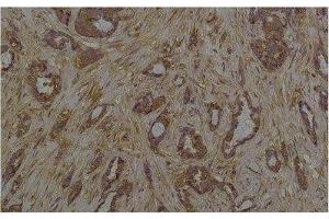Immunohistochemistry of paraffin-embedded Human breast carcinoma tissue with Phosphoserine Monoclonal Antibody at dilution of 1:200 (Phosphoserine anticorps)