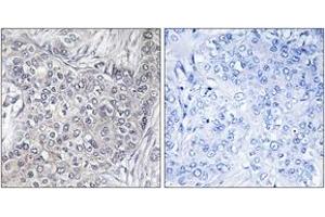 Immunohistochemistry analysis of paraffin-embedded human breast carcinoma, using 4E-BP1 (Phospho-Thr45) Antibody.
