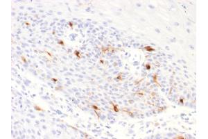 Formalin-fixed, paraffin-embedded human Basal Cell Carcinoma stained with TYRP1 Recombinant Rabbit Monoclonal Antibody (TYRP1/2340R). (Recombinant Tyrosinase-Related Protein 1 anticorps  (AA 257-377))