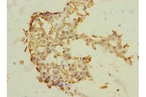 Immunohistochemistry of paraffin-embedded human breast cancer using ABIN7172186 at dilution of 1:100