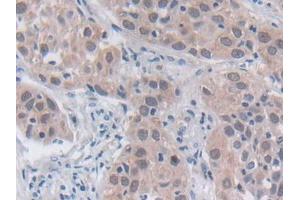 DAB staining on IHC-P; Samples: Human Lung cancer Tissue (SRY anticorps  (AA 1-204))