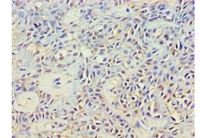 Immunohistochemistry of paraffin-embedded human breast cancer using ABIN7149353 at dilution of 1:100 (NCK2 anticorps  (AA 1-380))