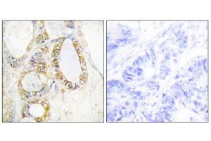 Immunohistochemistry analysis of paraffin-embedded human colon carcinoma tissue using Mucin 13 antibody. (MUC13 anticorps  (C-Term))
