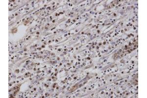 IHC-P Image Immunohistochemical analysis of paraffin-embedded human gastric cancer, using EAR2 , antibody at 1:100 dilution. (NR2F6 anticorps  (C-Term))